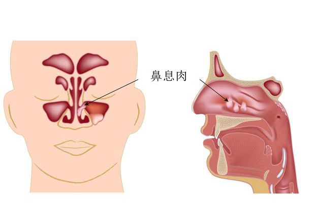 所有的息肉都会变成癌吗,所有结肠息肉都可能癌变吗