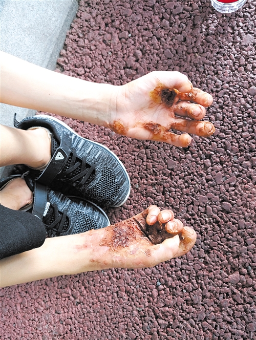 5岁脸部毛周角化症怎么治疗,2岁宝宝皮肤角化