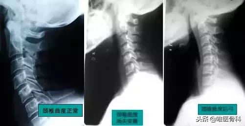 中央二台乌龟颈矫正训练,针对自己的乌龟颈怎么矫正