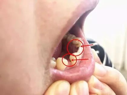 去口臭清洁口腔牙渍,口臭牙臭去除神器