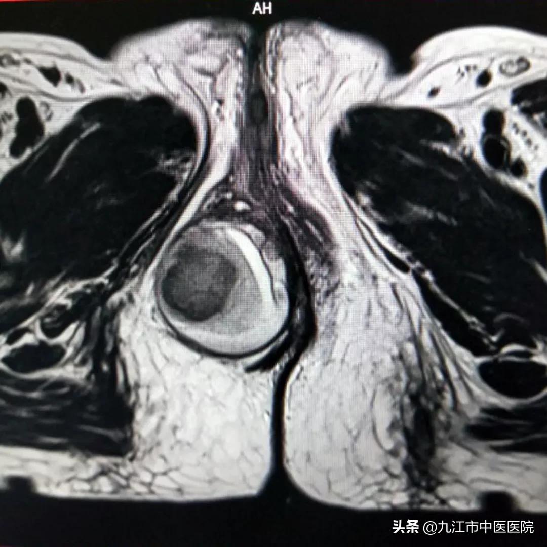 会阴血肿清除属于几级手术,会阴血肿清除术手术疼吗