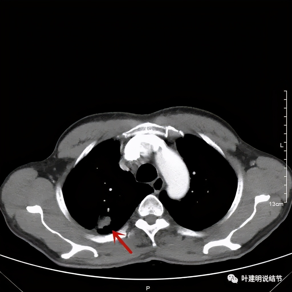 肺占位病理活检无病变,肺部占位穿刺病理说不确定性质