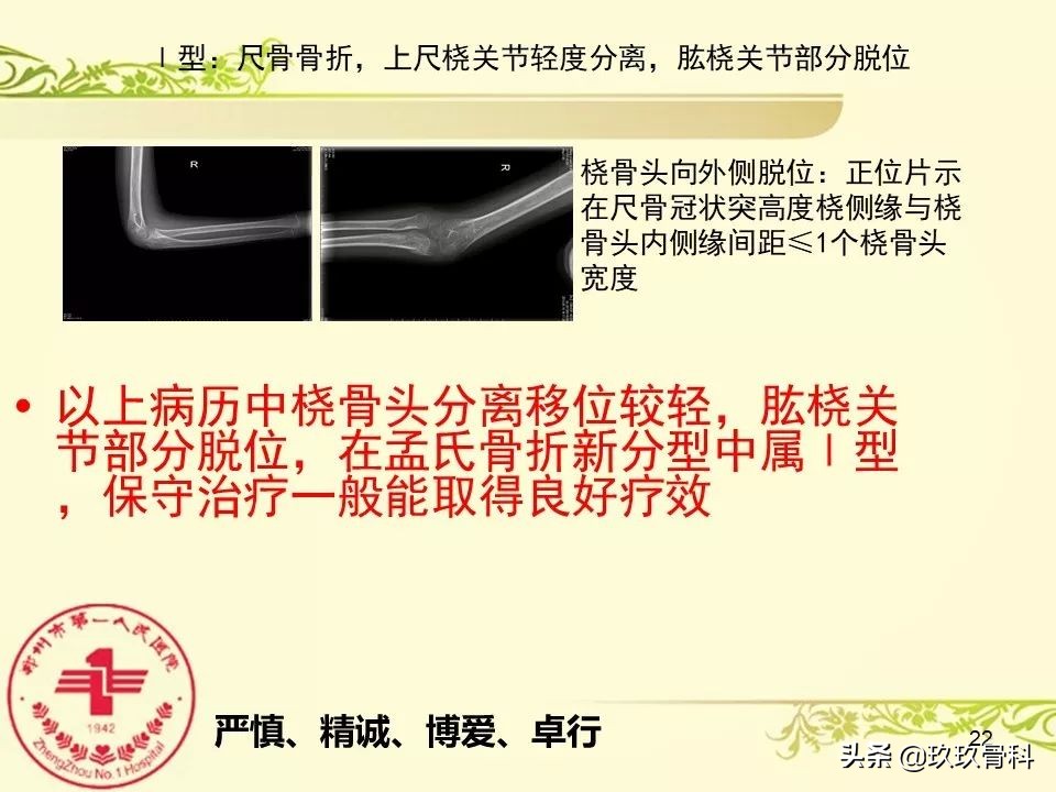 孟氏骨折功能训练多久能恢复正常,孟氏骨折中医能治吗