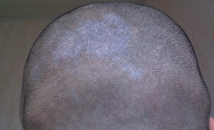 白癜风为什么毛发也会变白,白癜风为什么会导致白头发