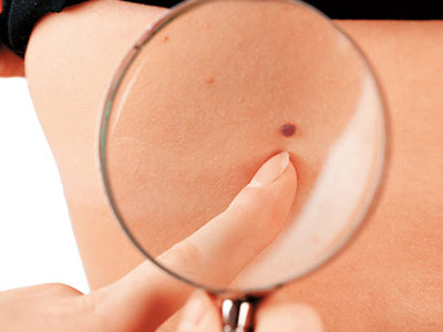 色素痣的首选治疗方式,激光治疗色素痣需要多少钱