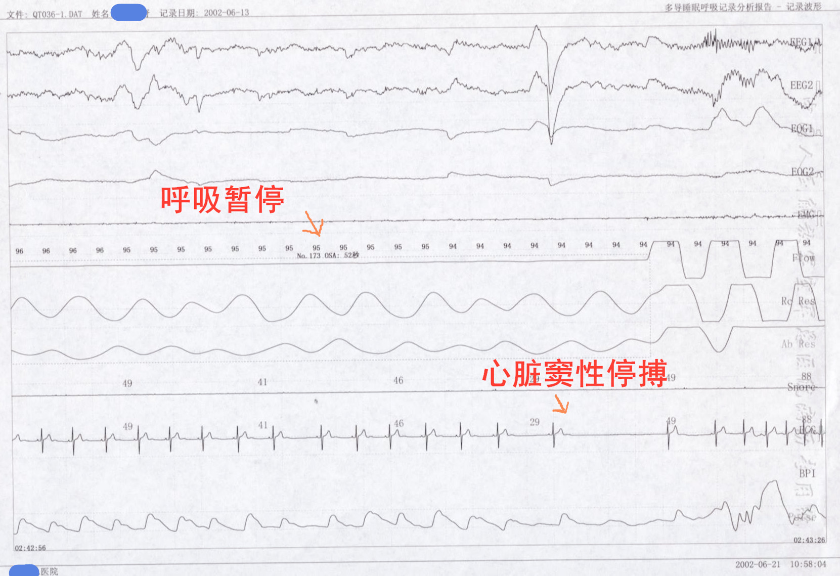 心律失常夜里发作,睡眠质量差导致的心律失常