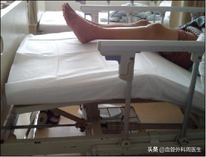 新冠感染怎样防静脉血栓,如何预防新冠引起的肺栓塞