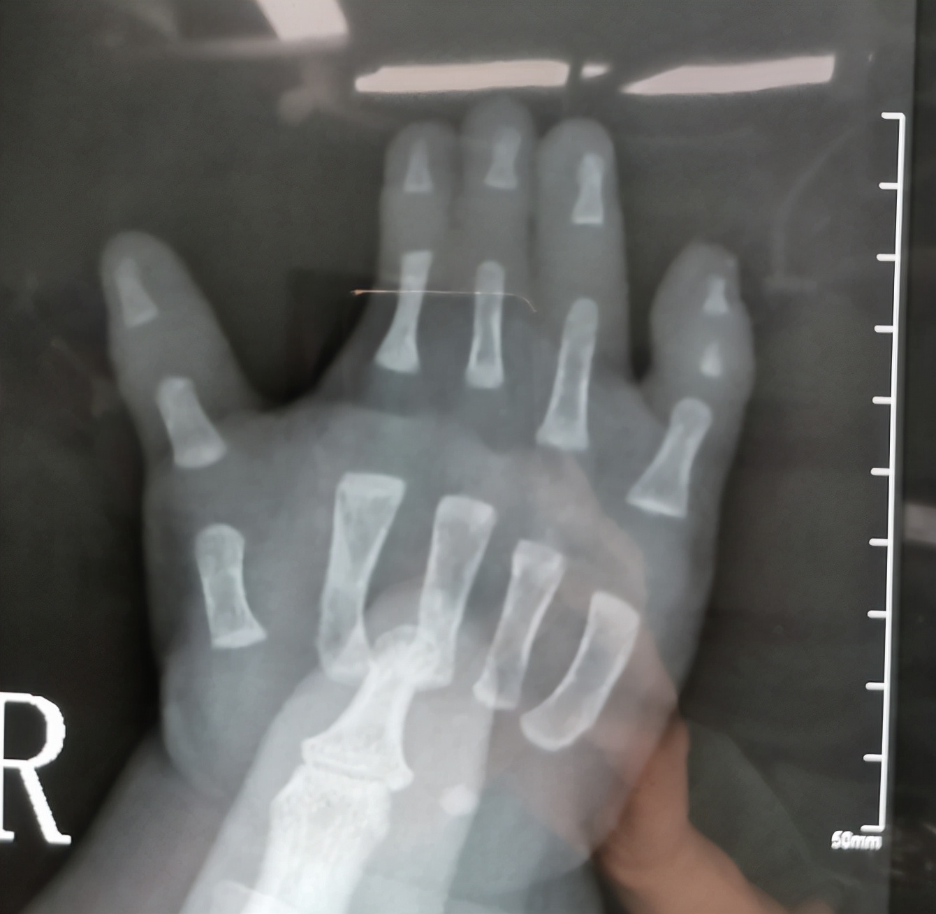 并指畸形免植皮案例,并指畸形