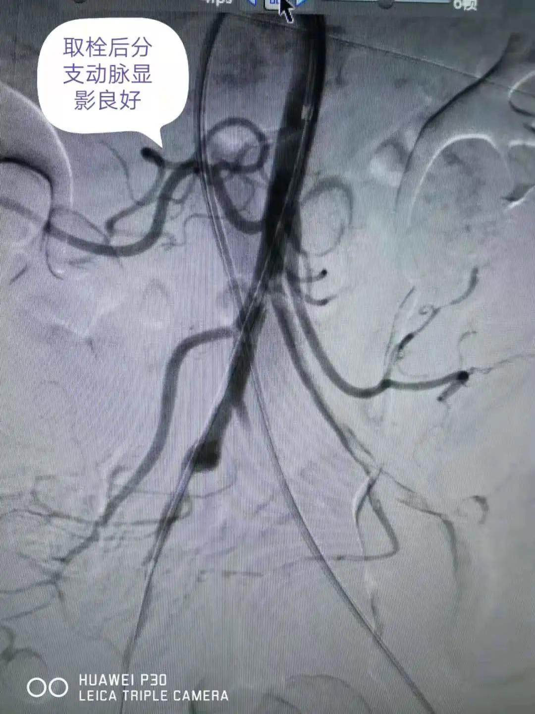 肠系膜动脉栓塞介入治疗,肠系膜下动脉栓塞介入治疗