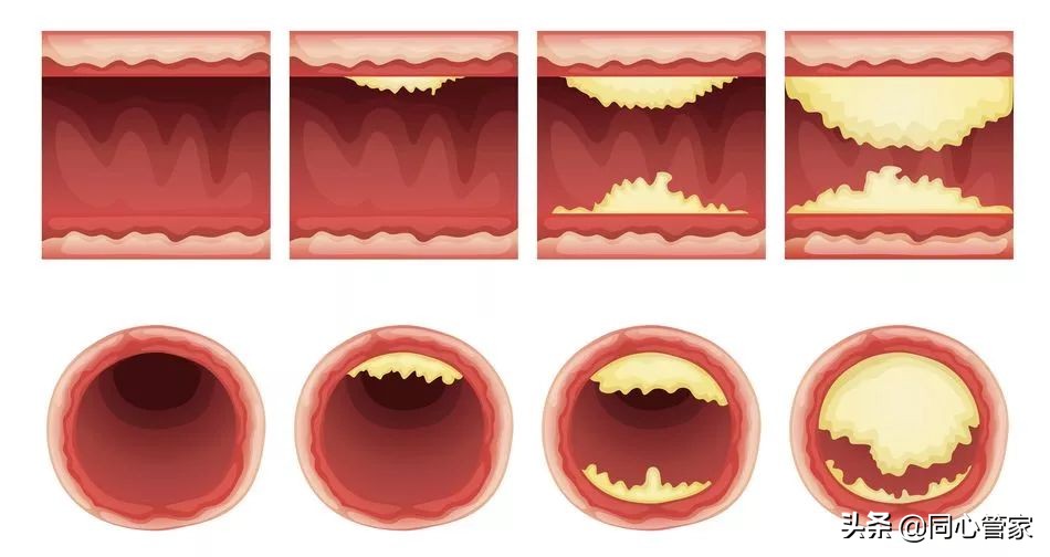 血管狭窄如何扼住生命的咽喉？让你全身器官都遭殃