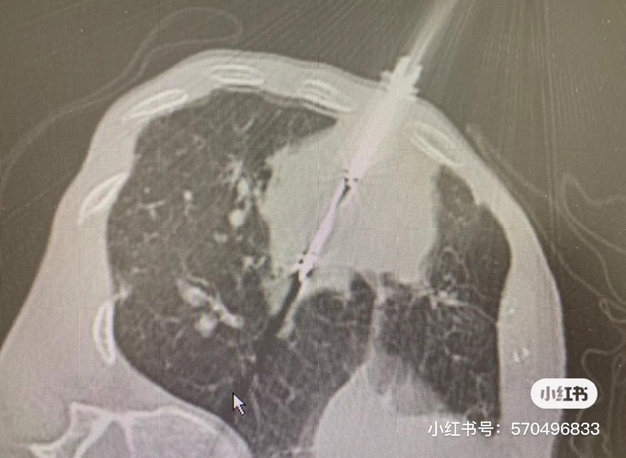 冷冻针治肿瘤能活多久,一根细针可以消除肿瘤