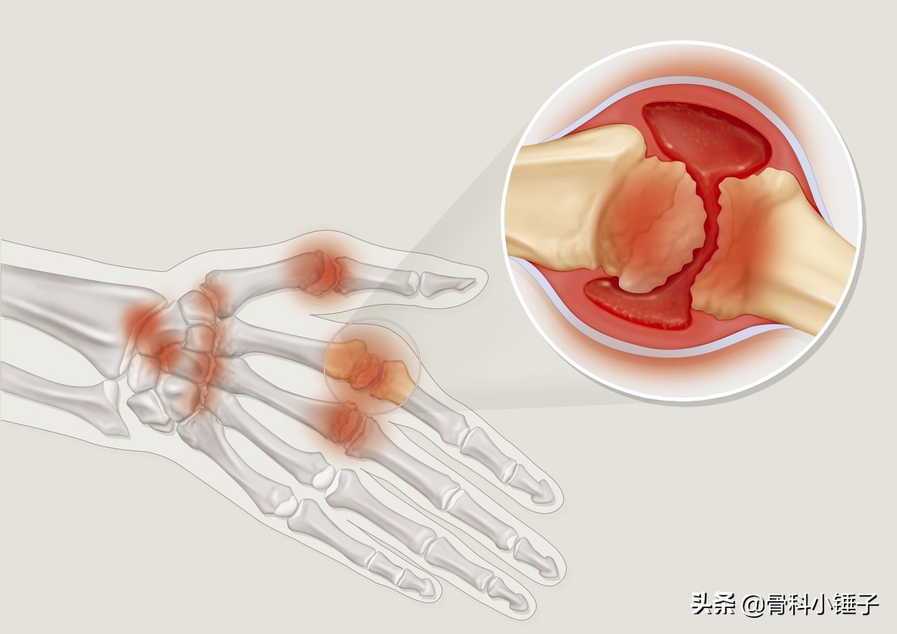 风湿病的治疗方法,风湿病腿疼有什么症状和治疗方法