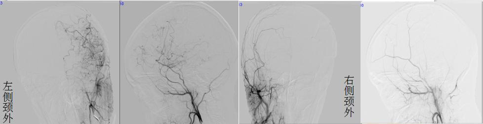 医生给脑血管搭桥,外科医生给年轻女孩做手术