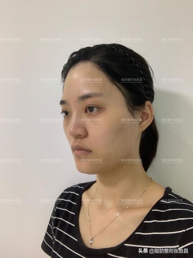 自体脂肪胶填充太阳穴泪沟法令纹,自体脂肪太阳穴填得太饱满了