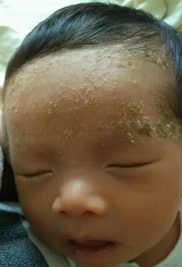 孩子湿疹老不好,孩子长期湿疹的最佳治疗方法