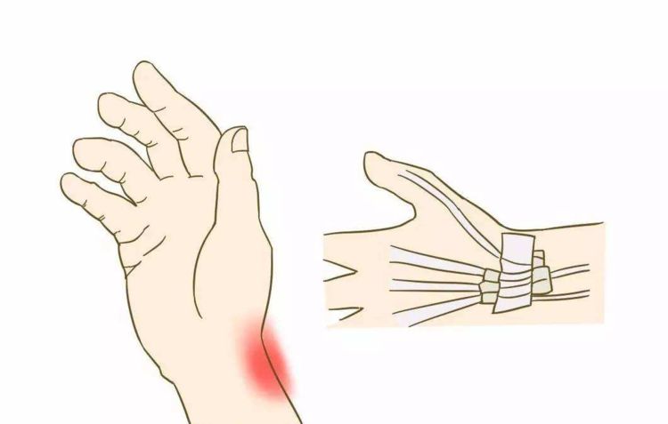 大拇指不敢动还很疼？可能是腱鞘炎，手脚别太“勤快”该歇就歇会