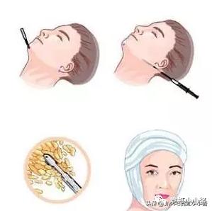 记录翻译小姐姐日本打溶脂针，肉脸变骨感脸全过程｜日本医美