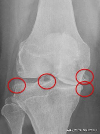 为什么感觉膝盖没力气,为什么感觉膝盖不舒服