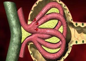 腰椎间盘突出血管瘤是怎么回事,椎管血管瘤