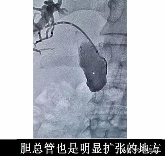 病人眼睛变成黄色是什么原因,病人眼珠白色部位变黄