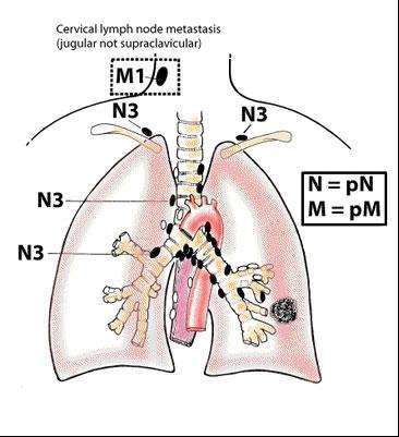 肺癌早期和晚期怎么判断,肺癌早中晚期如何区分