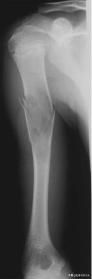 骨折的影像学检查及各自的优势,骨折的影像学愈合标准