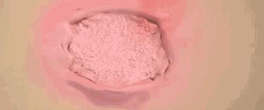 手术切口为什么会感染,什么情况下切口会感染