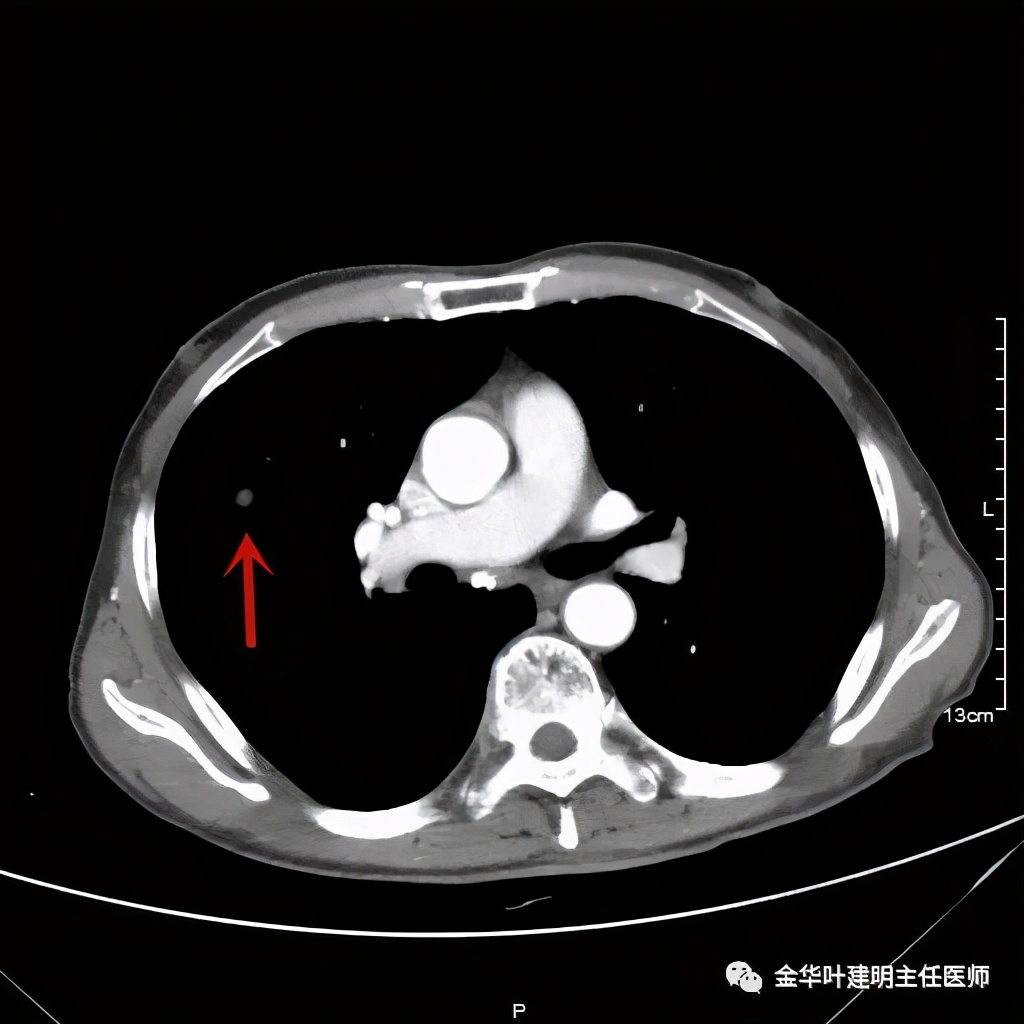 得了肺癌做肺部穿刺有影响吗,肺部穿刺可以确诊肺癌吗