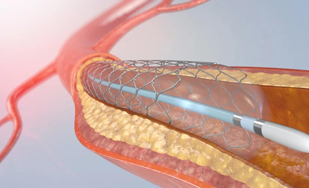 做完tips支架手术复查用不用住院,心脏支架后多长时间做一次cta复查