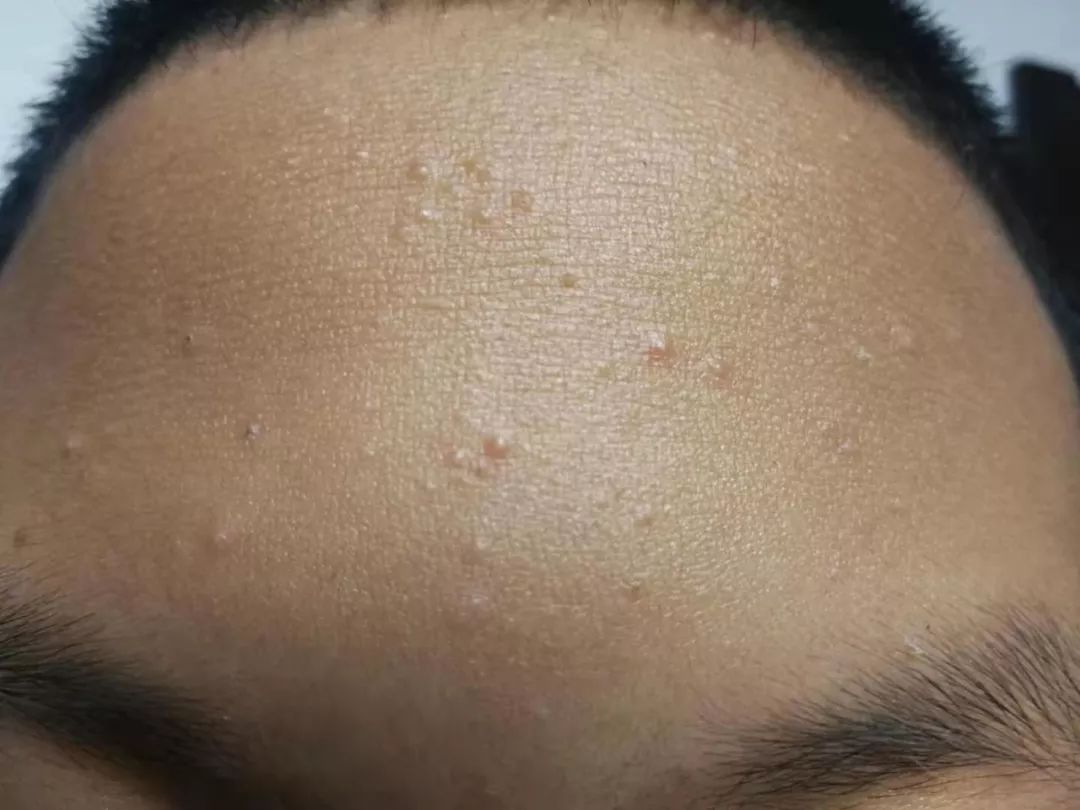 屏障受损起闭口粉刺多长时间能好,不要小看了闭口粉刺