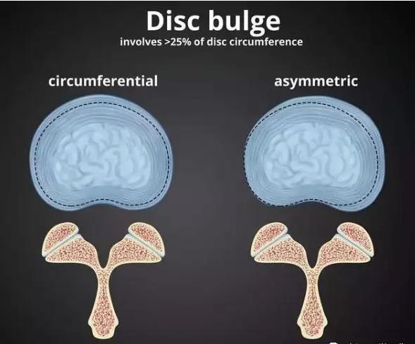 腰椎间盘的膨出和突出有什么区别,腰椎间盘突出膨出骨质增生怎么治