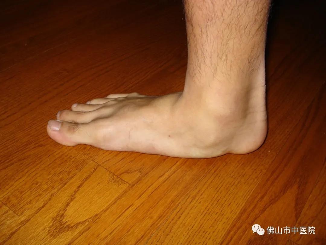 儿童扁平足的矫正训练,儿童矫正扁平足的最佳锻炼方法