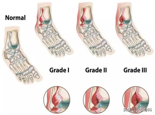 习惯性脚踝扭伤3年怎么治疗,习惯性扭伤脚踝隐隐作痛