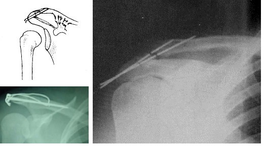 肩锁关节脱位治疗,肩锁关节脱位