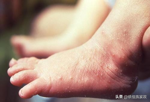 冬季皮肤湿疹饮食应注意什么,春季宝宝湿疹最佳治疗方法