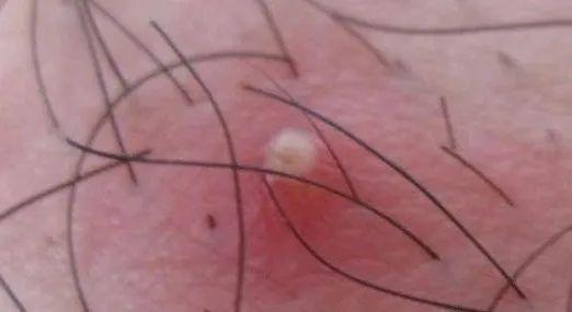 阴囊湿疹的3大表现症状!一旦出现,立即就医