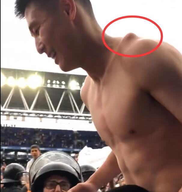 肩锁关节脱位复位视频,肩锁关节脱位固定带