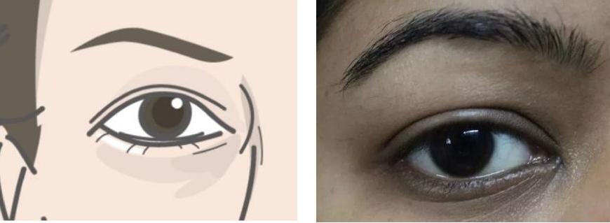 如何改善黑眼圈最有效,黑眼圈是怎么形成的如何淡化