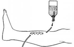手术后麻药导致头痛多久才能痊愈,感染后一直头痛怎么办