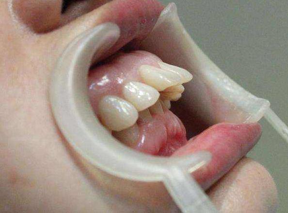 龅牙属于复杂正畸吗,整齐的龅牙是不是最好矫正的