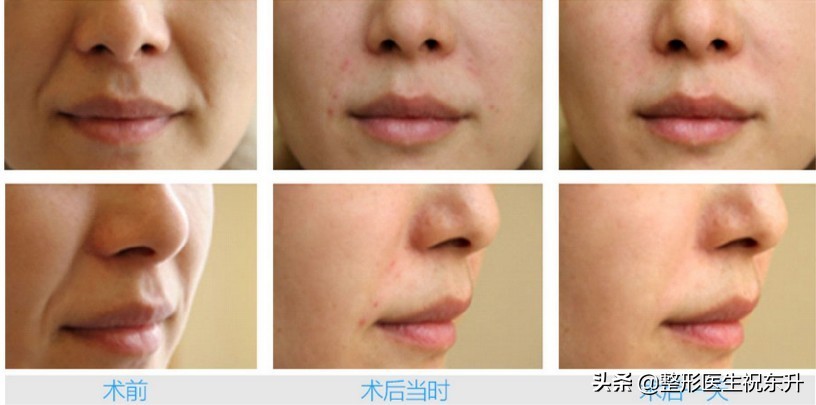线雕和玻尿酸填充法令纹哪个安全,玻尿酸填充法令纹好还是线雕好呢