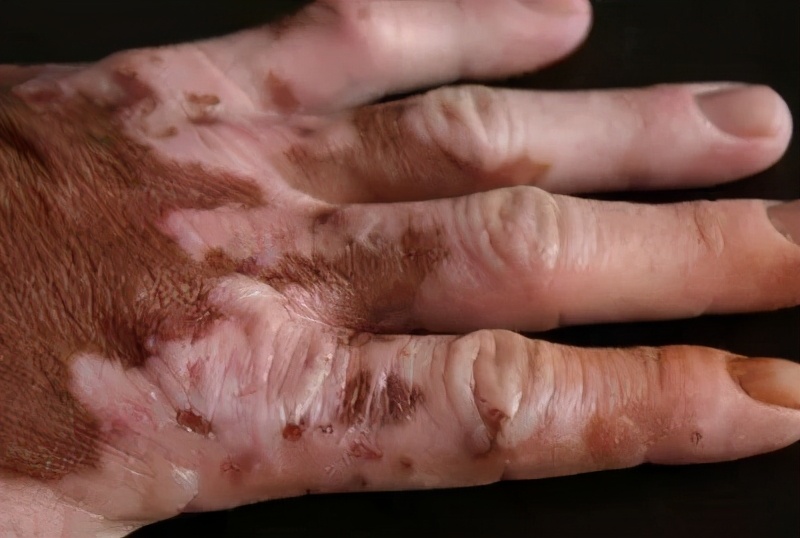 幼儿白癜风分几种类型啊,白癜风都有什么类型