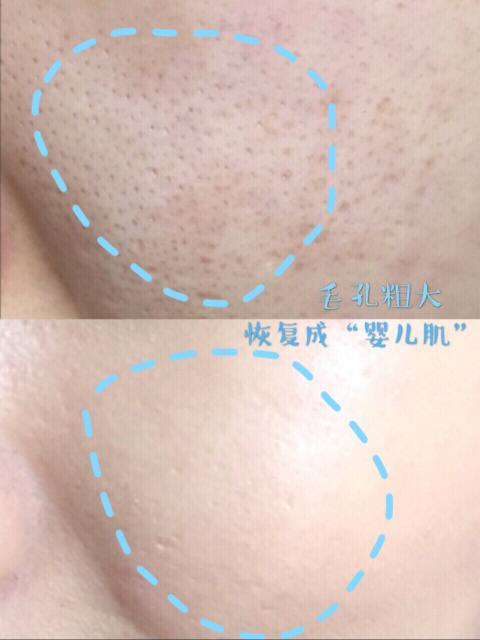 100人里就有20人中招，清洁不到位导致脸上冒虫，毛孔需要早清洁