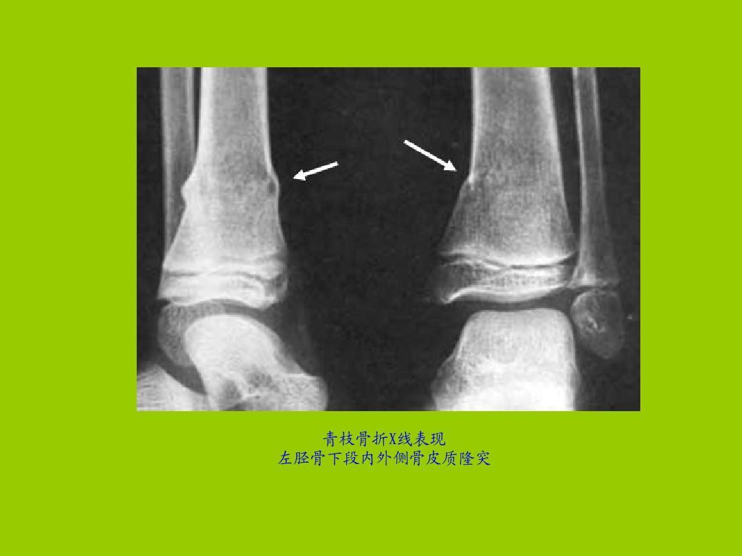 听小骨轻微损伤是什么导致的,听小骨损坏能听到声音吗