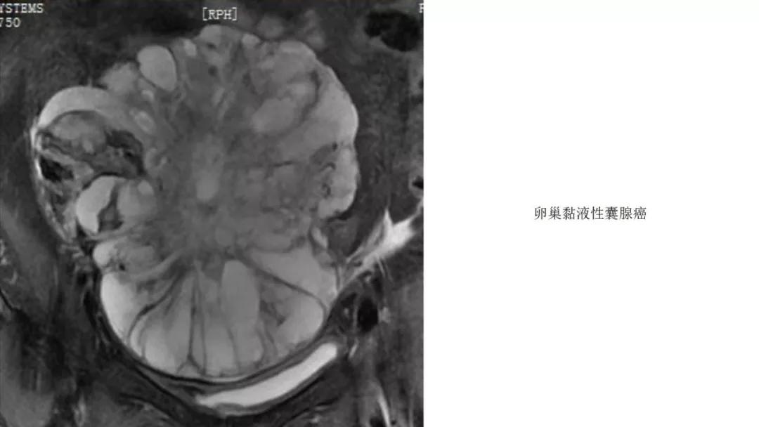 卵巢原发肿瘤的分析思路