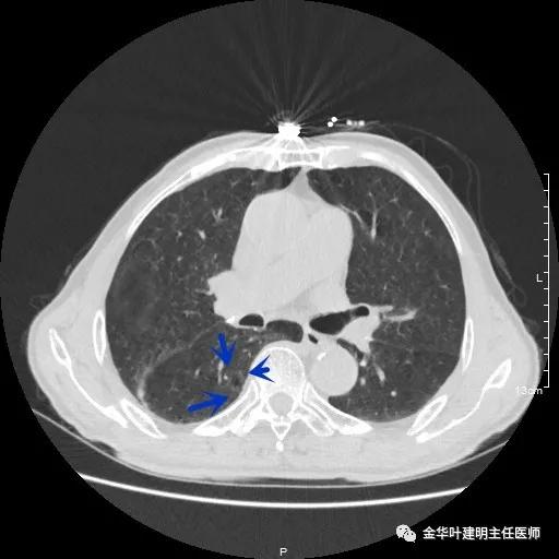 多发原发肺癌能根治吗,肺部原发性恶性肿瘤好治