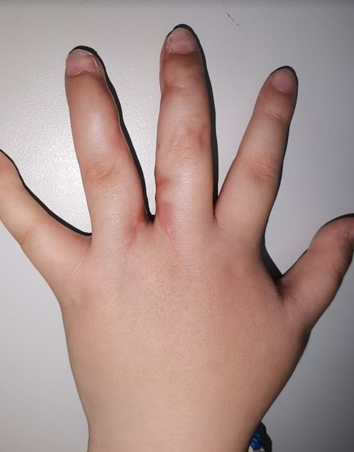 并指畸形免植皮案例,并指畸形