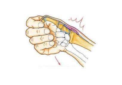 妈妈手如何恢复健康,妈妈手怎么处理