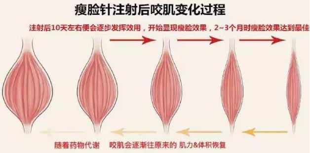 瘦脸针讲解视频,瘦脸针的原理与作用安全有效