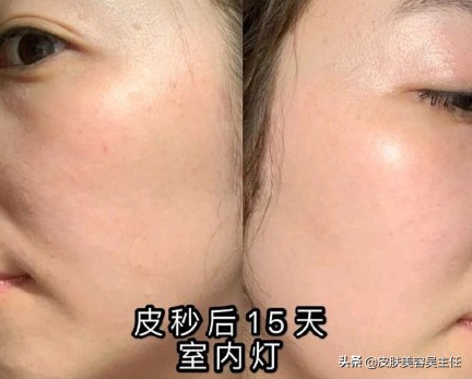 激光可以祛斑祛痣吗,激光可以彻底祛斑吗多少钱